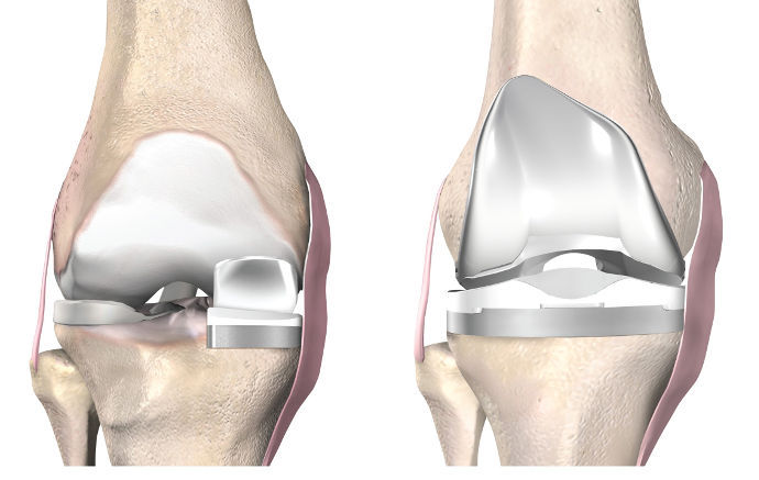Γόνατο με Μονοδιαμερισματική Αρθροπλαστική - Γόνατο με Ολική Αρθροπλαστική