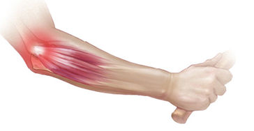 tennis elbow